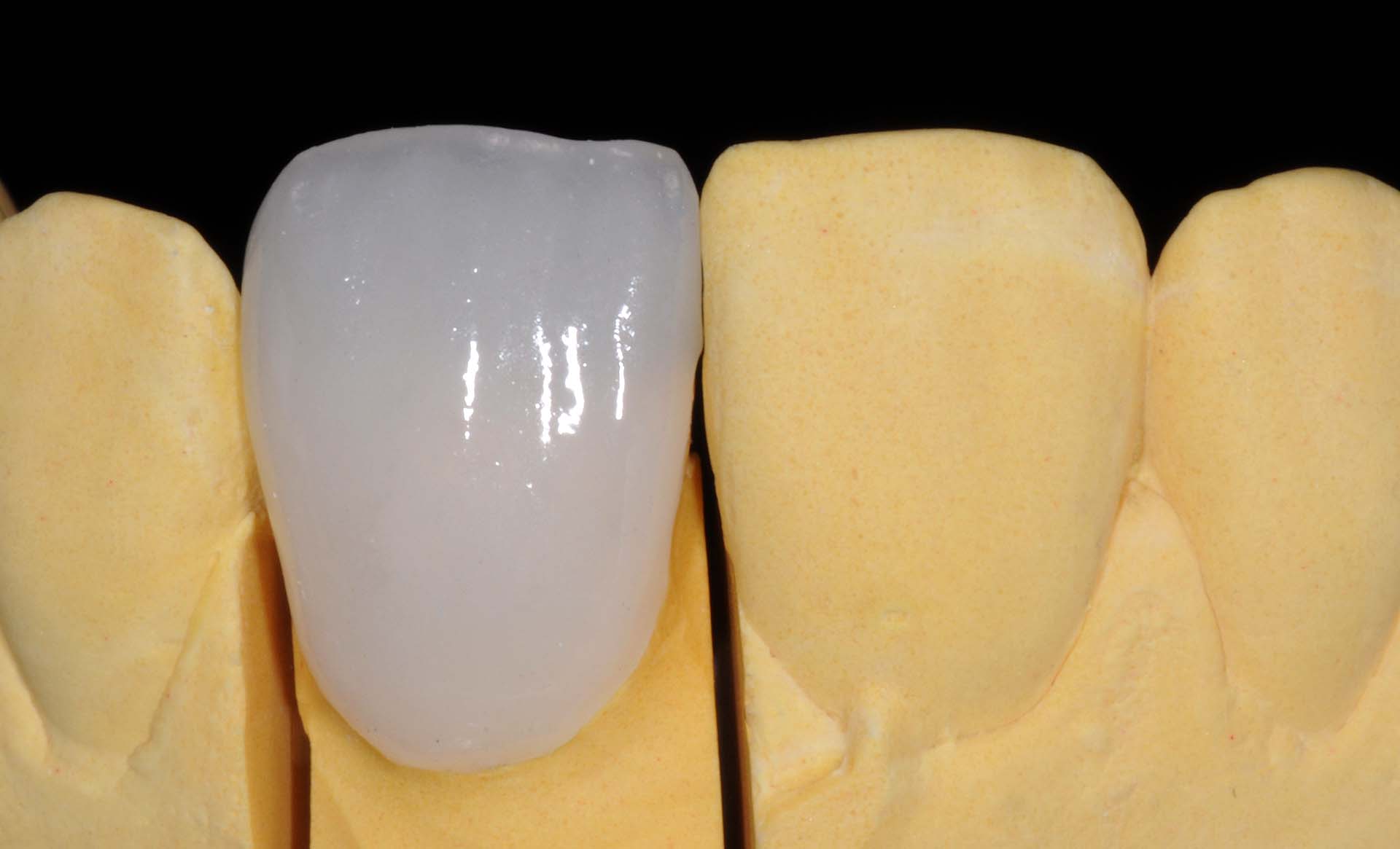 Veneer 21